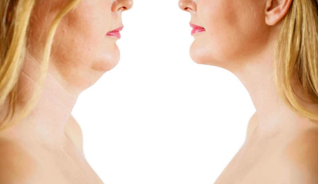 Double Chin treatment Lower Morden before and after results