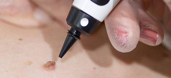 After Skin Tag Removal Lower Morden