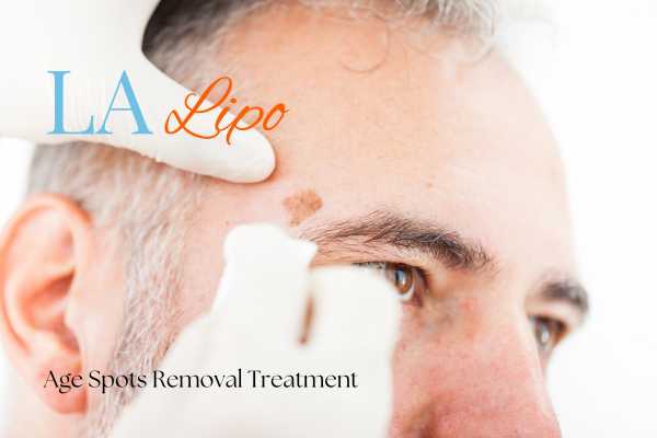What Are the Most Effective Treatments for Age Spots Lower Morden?