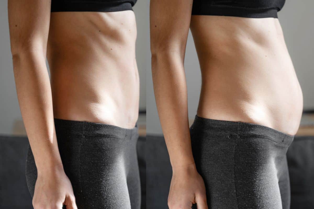 How long does diastasis recti take to improve Lower Morden?