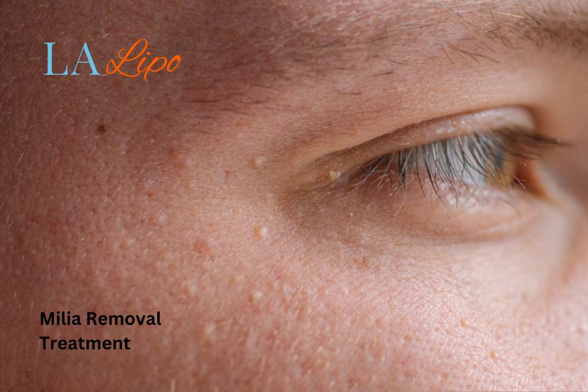 Cryopen Milia Removal: Is It the Easiest and Safest Option Lower Morden?
