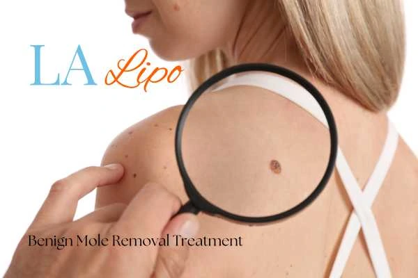 Woman having her inspection of blemish before mole removal Lower Morden