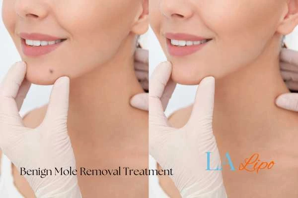 Before and after mole removal Lower Morden treatment