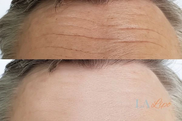 results of HIFU Lower Morden on mans forehead to help reduce lines and wrinkles