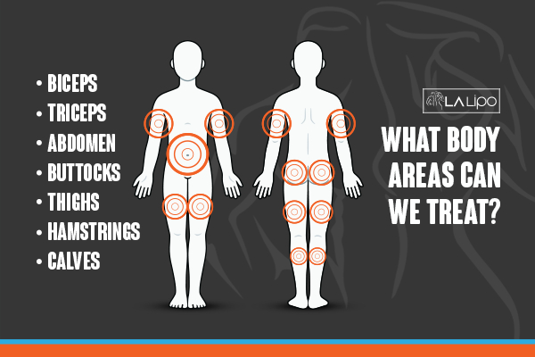 Graphic to show areas you can have LA-EMS Body Sculpting Lower Morden treatment.