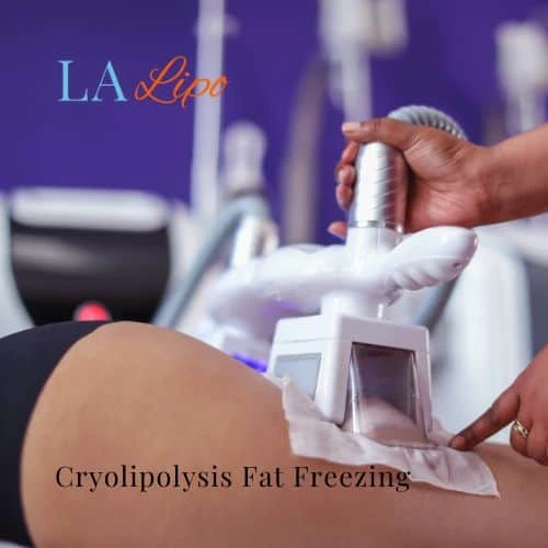 fat freezing - Cryolipolysis Lower Morden