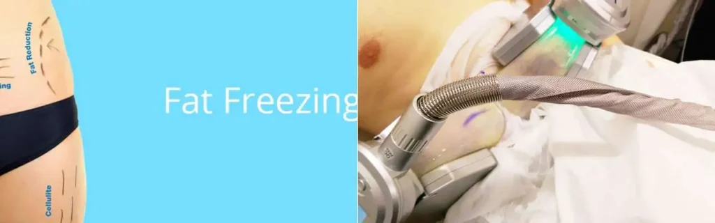 multi areas of a persons body having coolsculpting Lower Morden treatment
