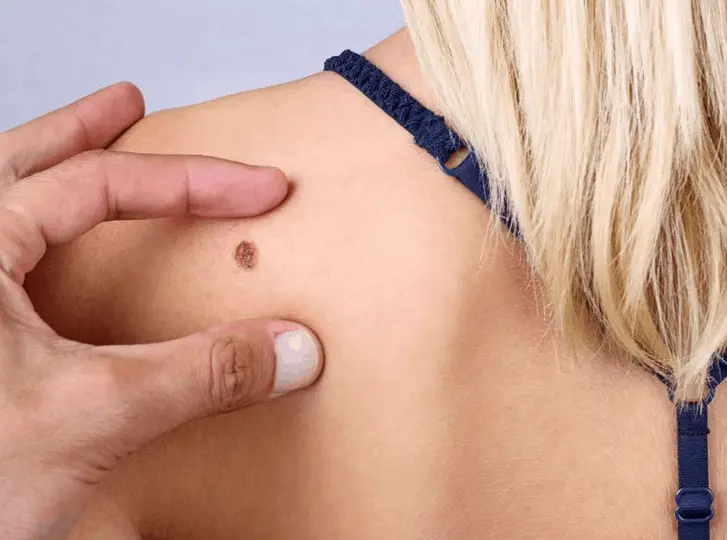 woman having mole removal Lower Morden consultation before treatment.