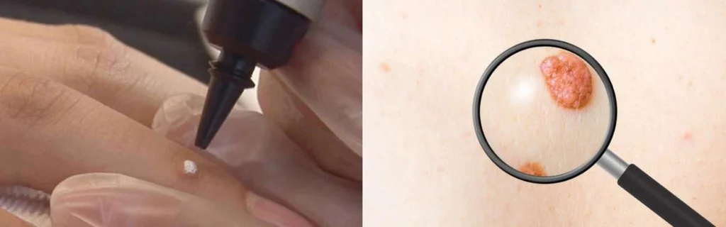 Person getting moles removed with cryopen Lower Morden