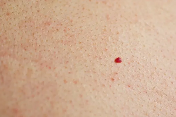 close up of a cherry angioma Lower Morden
