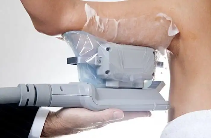 Picture of fat freezing Lower Morden on the upper arms.