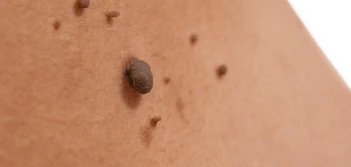 image of a skin tag Lower Morden