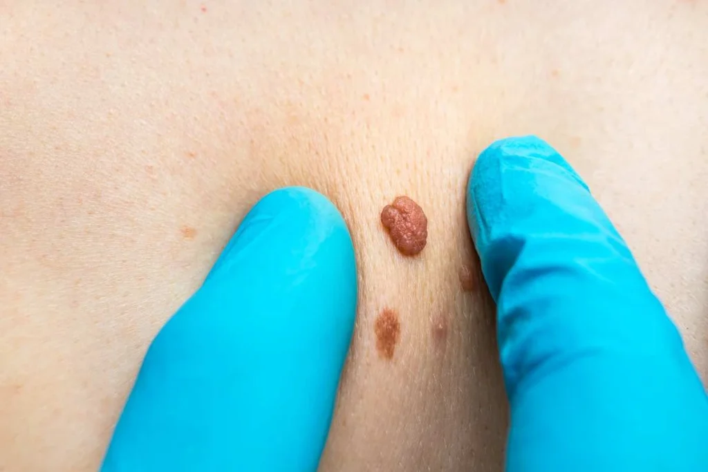 Consultant examining a skin tag Lower Morden