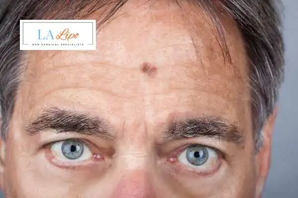 Solar Lentigo Removal Lower Morden image of man with mark on his forehead