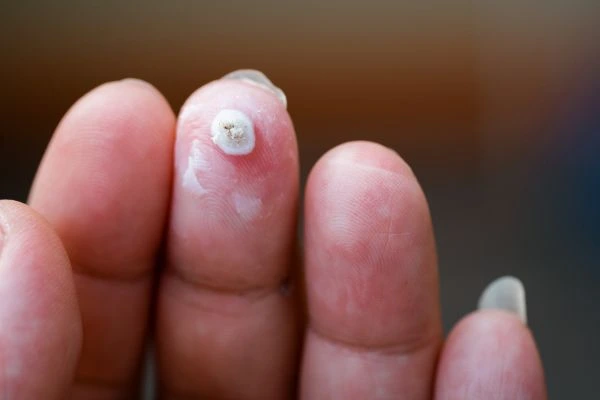 wart on person finger - cryotherapy to treat from LA LIPO Lower Morden
