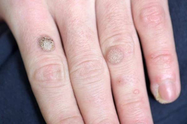 photo of warts on person hand - see wart removal Lower Morden from LA LIPO