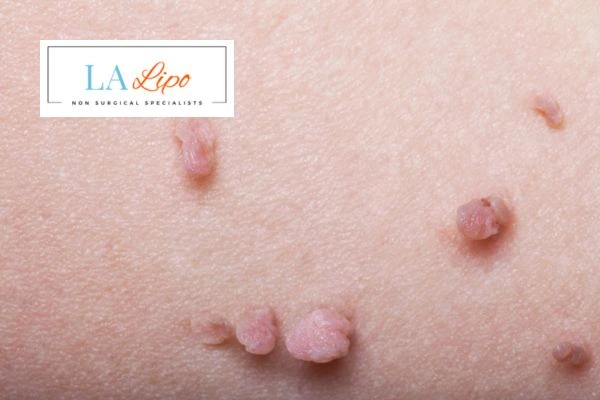 Does cryopen skin tag removal Lower Morden hurt? Find out now call our team today!