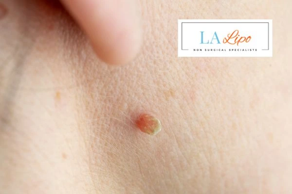 Book skin tag removal Lower Morden today speak to our team now!