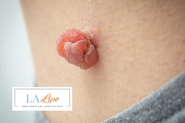 Interested in skin tag removal Lower Morden? Concerned about the pain? Find out more today!