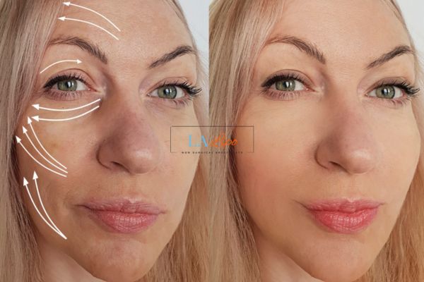 Morpheus 8 results Lower Morden face lift.