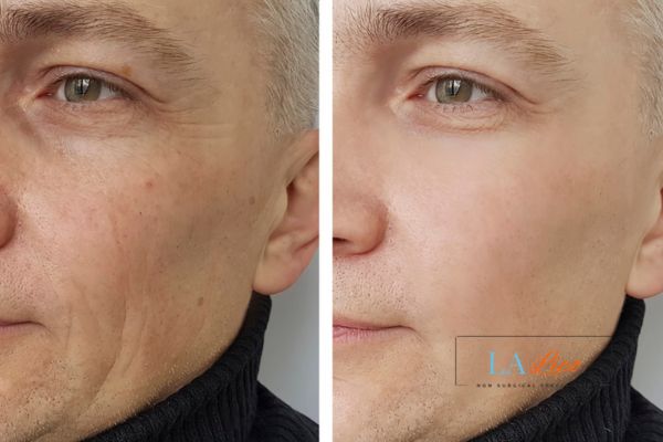 See the amazing results of Morpheus8 Treatment Lower Morden!