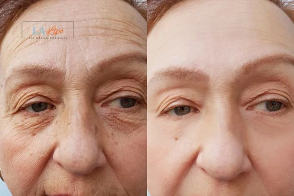 The powerful benefits of Morpheus8 Treatment Lower Morden - Call Our team today!