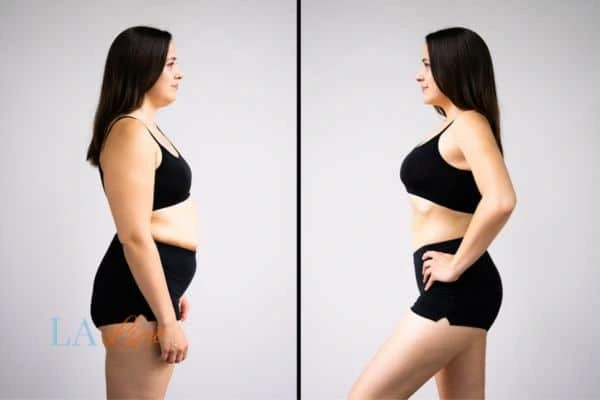 Picture of womans before and after using LA-EMS body sculpting to improve her core strength Lower Morden