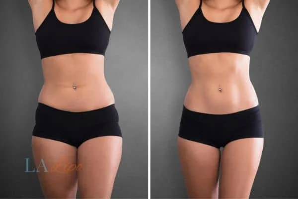before and after results of non-surgical treatment to help a woman's body image and mental health Lower Morden
