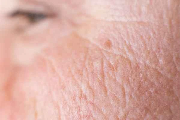 close up picture of a woman's face showing an age spot Lower Morden