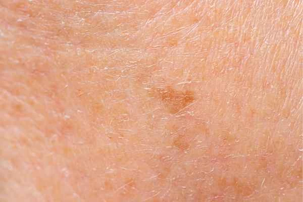 close up picture of age spots Lower Morden