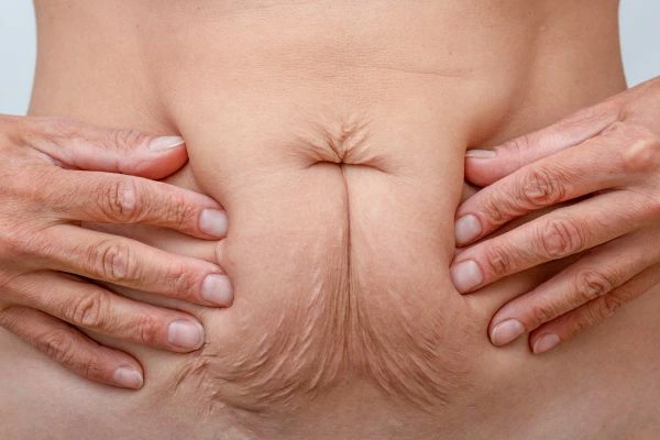 Image of a woman's stomach with loose skin - example of skin tightening Lower Morden options