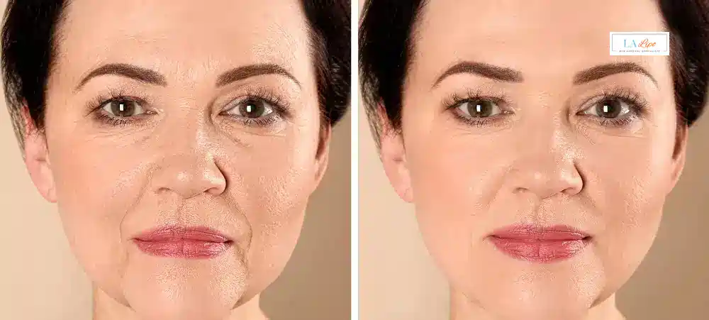How Long Does It Take to See Results and How Long Do They Last Lower Morden?